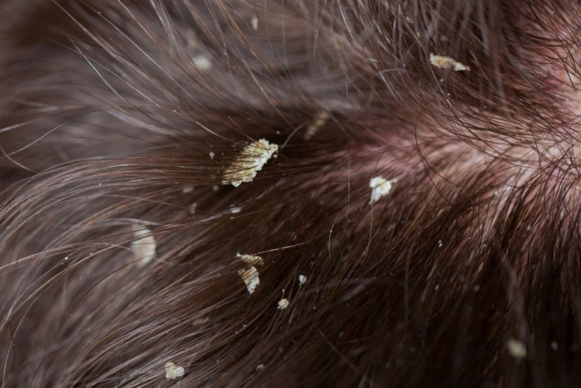 Kulit Kepala Gatal Itchy Scalp Penyebab Dan Cara Menghilangkannya