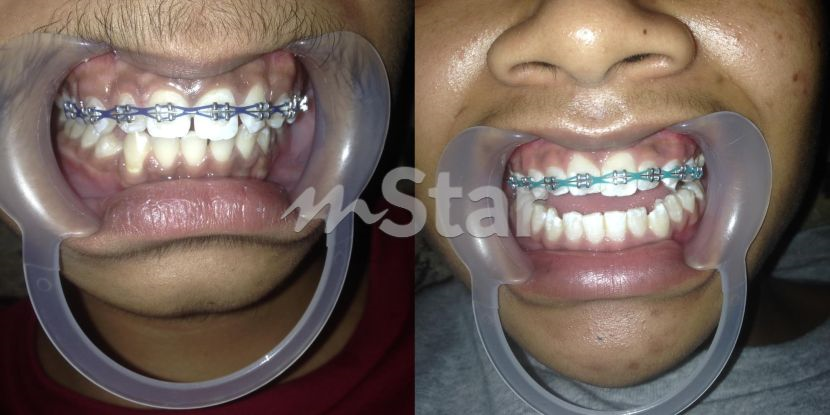 Gadis tawar u0027bracesu0027 murah promosi akhir tahun tapi apabila Dr 