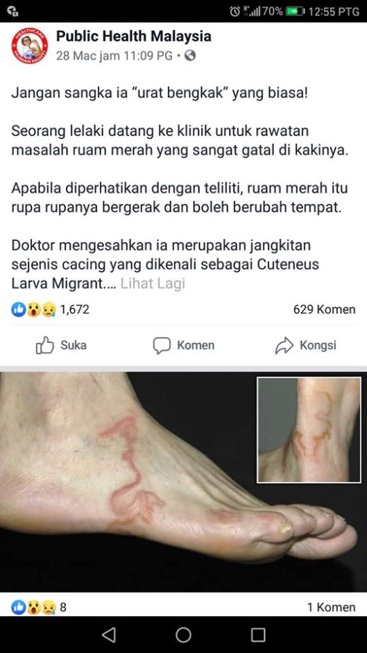 Sakit Urat Selepas Ke Pantai Siap Mengurut Rupa Rupanya Cacing Berzumba Dalam Kaki Jangan Ulangi Apa Yang Wanita Ini Buat Viral Mstar