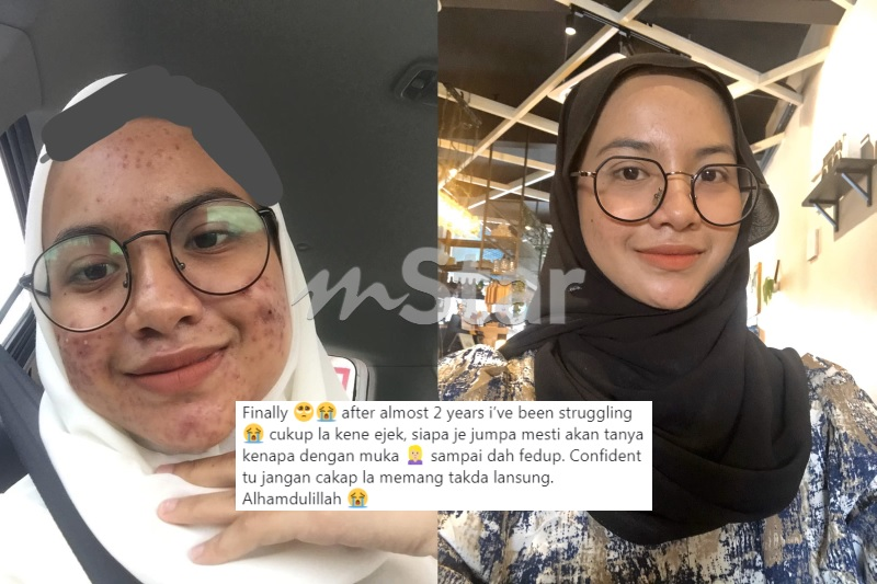 Muka Anak Disamakan Macam Bulan Ibu Yang Rasa Sakit Nekad Bawa Gadis Ini Jumpa Pakar Kali Pertama Rawatan Mereka Picit Jerawat Saya Viral Mstar