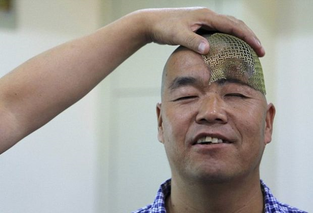 Teknologi Pencetak 3D Pelengkap Tempurung Kepala Dunia Teknologi Pencetak 3D Pelengkap Tempurung Kepala Dunia